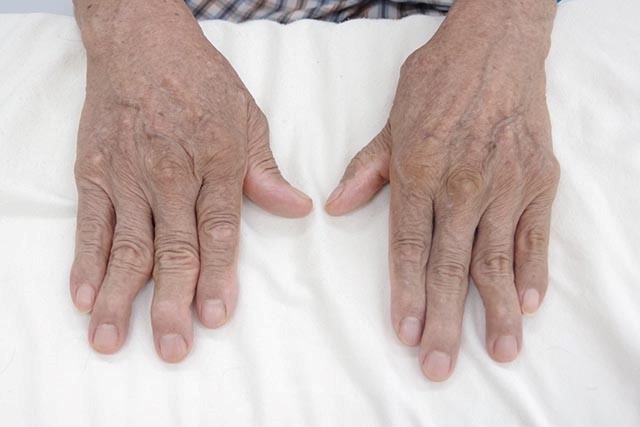 Biến chứng của bệnh viêm đa khớp dạng thấp