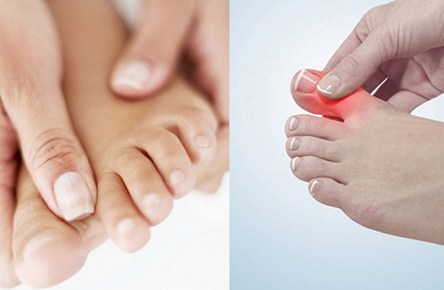 Đau khớp ngón chân kèm biểu hiện sưng tấy, cứng khớp