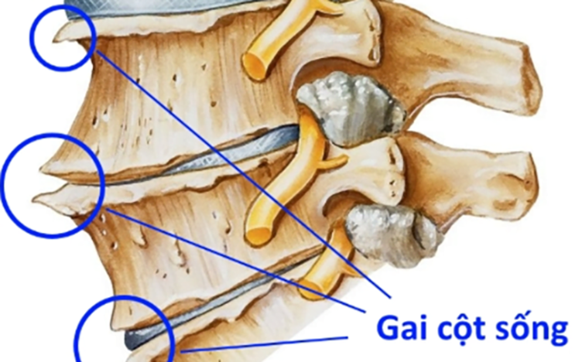 hình ảnh gai cột sống thắt lưng