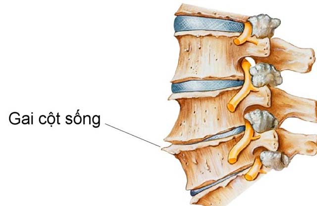 hình ảnh gai cột sống ưng