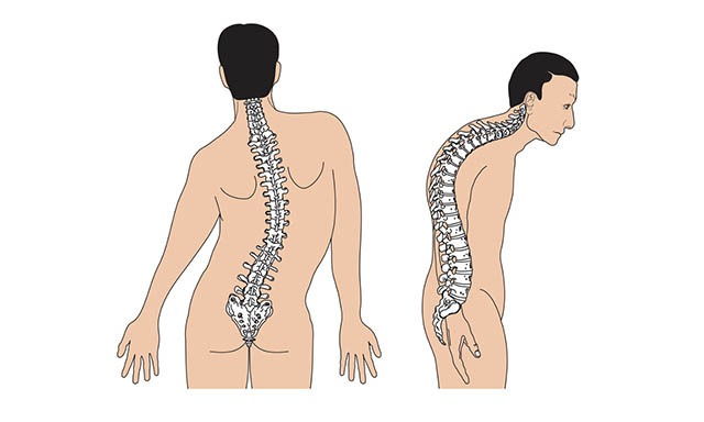 Cột sống bị biến dạng do bệnh thoái hóa đốt sống lưng
