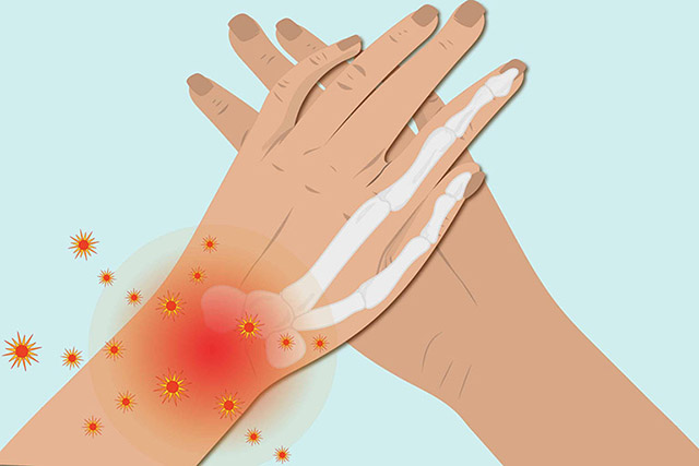 Viêm khớp cổ tay có thể gây tràn dịch khớp cổ tay