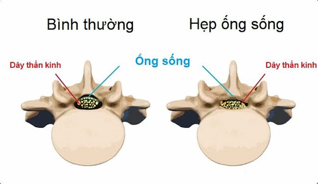 Hẹp ống sống là tình trạng ống sống bị thu hẹp, gây áp lực lên ống sống, rễ thần kinh