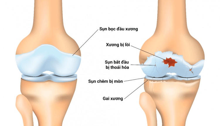  Đi bộ tập thể dục giúp bảo vệ mô sụn