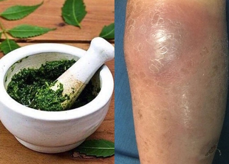 Thuốc đắp xương khớp - Phương pháp an toàn, hiệu quả được nhiều người áp dụng