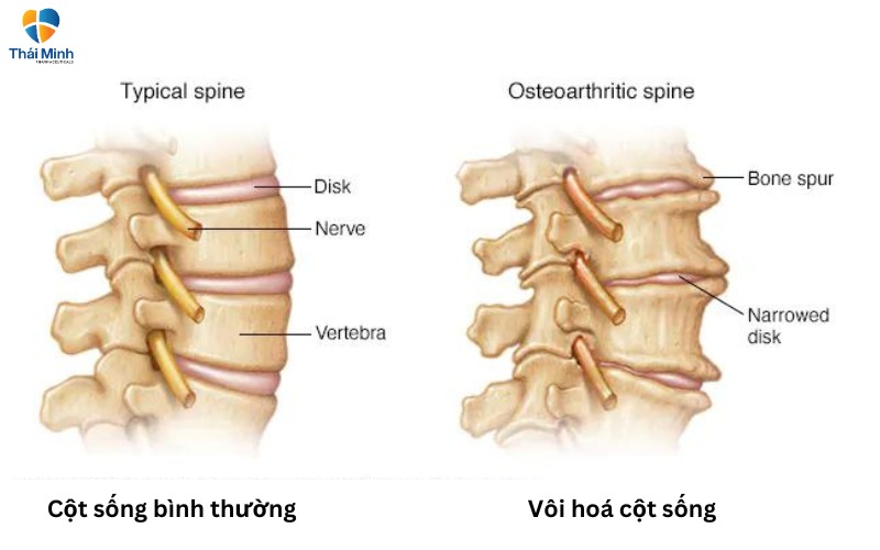  Hình ảnh vôi hoá cột sống