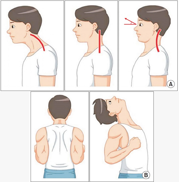  Các bước thực hiện Head retraction - Bài tập giúp kéo căng và cải thiện các nhóm cơ cổ bị yếu