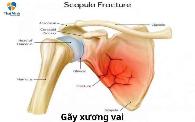  Gãy xương vai là một trong các nguyên nhân khiến khớp vai kêu lục cục