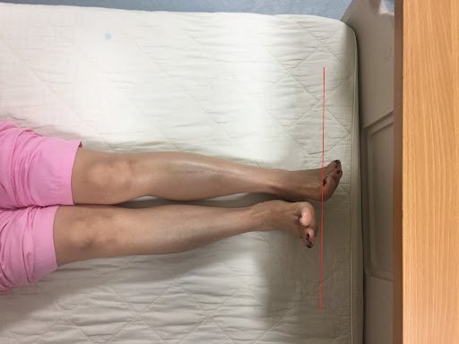  Biến chứng của lệch xương chậu
