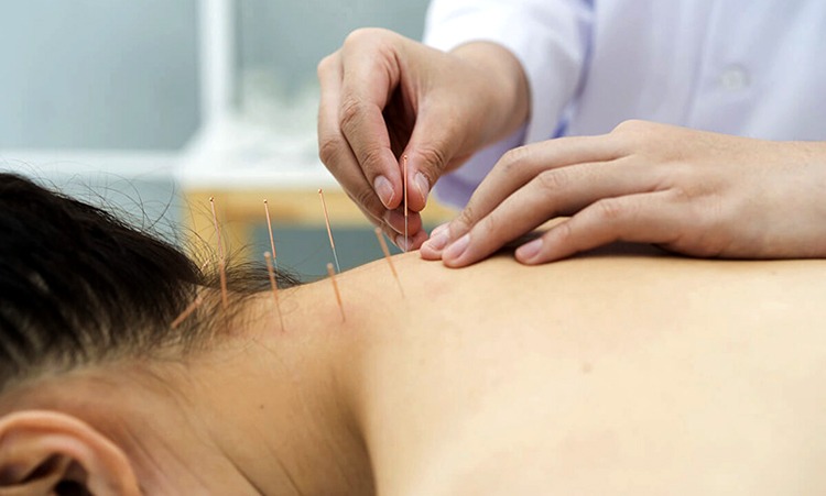  Biện pháp châm cứu cho đối tượng bị đau cổ bên phải nặng