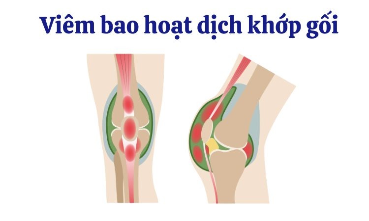  Hình ảnh viêm bao hoạt dịch ở khớp gối
