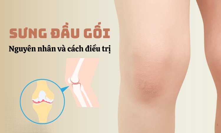  Tìm hiểu về tình trạng sưng đau đầu gối