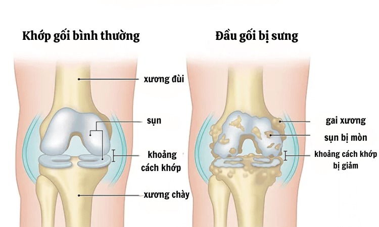  Hình ảnh đau và sưng ở khớp gối