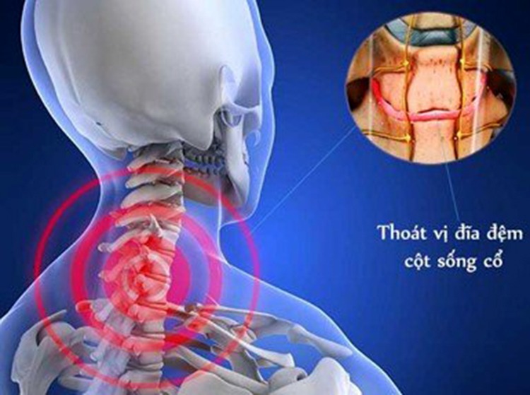  Thoái hoá cột sống thường xảy ra ở người lớn tuổi