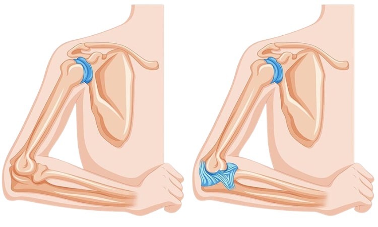  Trật khớp khuỷu tay là nguyên nhân không quá phổ biến