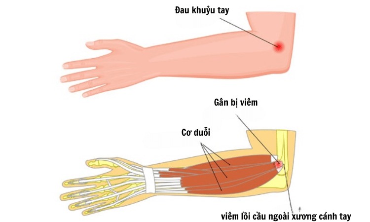  Hình ảnh đau khớp ở khuỷu tay