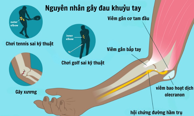  Nguyên nhân gây đau khớp khuỷu tay