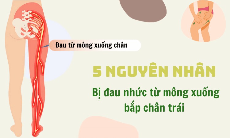  Tìm hiểu nguyên nhân đau từ mông xuống bắp chân