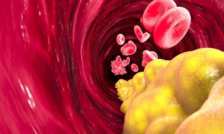  Giúp hạ lipid máu và ngăn ngừa xơ vữa động mạch