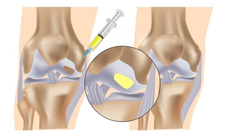 Tiêm tế bào gốc vào khớp gối