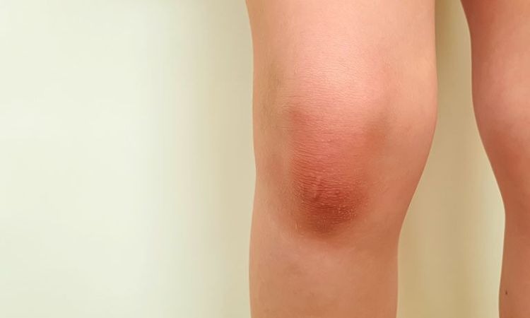  Gối hạc giúp giảm sưng đầu gối