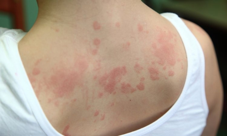  Vòi voi có tác dụng điều trị viêm da cơ địa