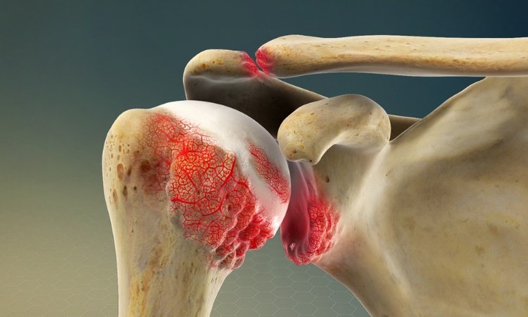  Dấu hiệu phổ biến nhất là đau khớp vai