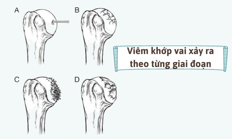 Những giai đoạn khi bị viêm khớp vai