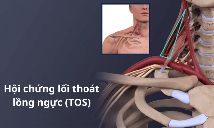  Hội chứng lối thoát lồng ngực cũng là nguyên nhân gây đau vùng vai gáy