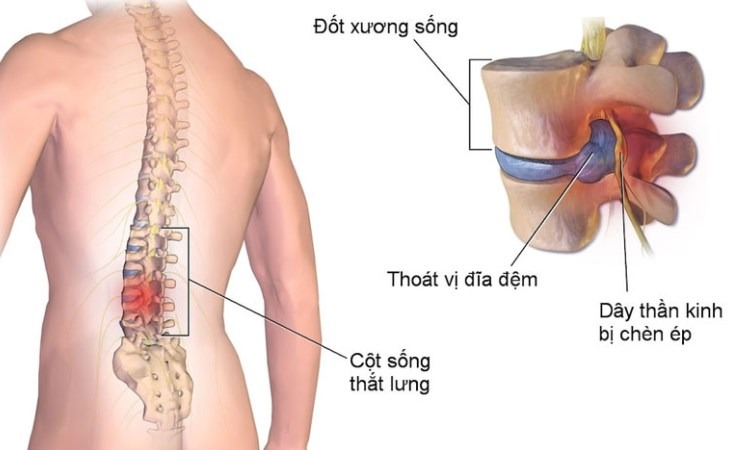  Hình ảnh đau thắt lưng bên trái
