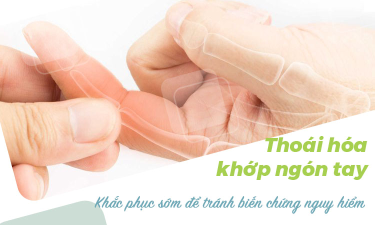 Thoái Hóa Khớp Ngón Tay: Dấu Hiệu Nhận Biết Và Cách Điều Trị