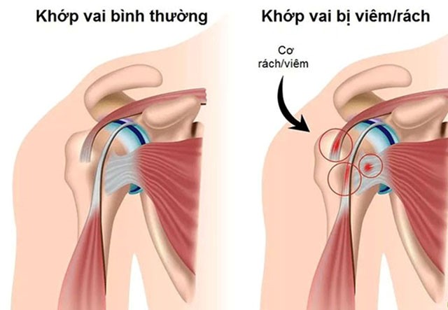Bệnh viêm quanh khớp vai là gì? Viêm khớp vai uống thuốc gì?